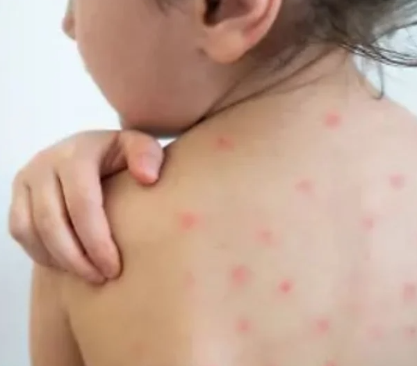 Navojoa en alerta por casos sospechosos de sarampión