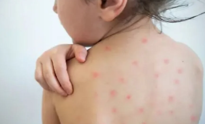 Navojoa en alerta por casos sospechosos de sarampión