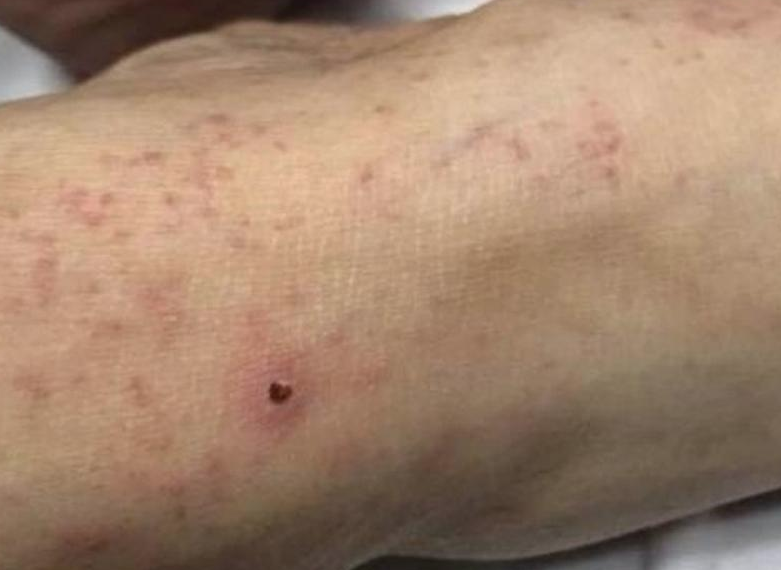 Navojoa registra tres nuevas muertes por rickettsia con letalidad del 40%